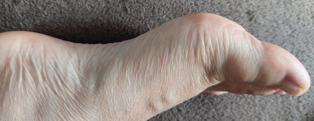 VOYOR BM300 Epilierer Fuß nach der Hornhautbehandlung