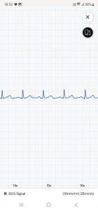 Withings ScanWatch 2 Smartwatch App EKG
