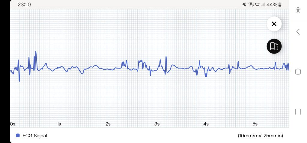 Withings ScanWatch 2 Smartwatch App EKG (2)