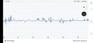 Withings ScanWatch 2 Smartwatch App EKG (2)