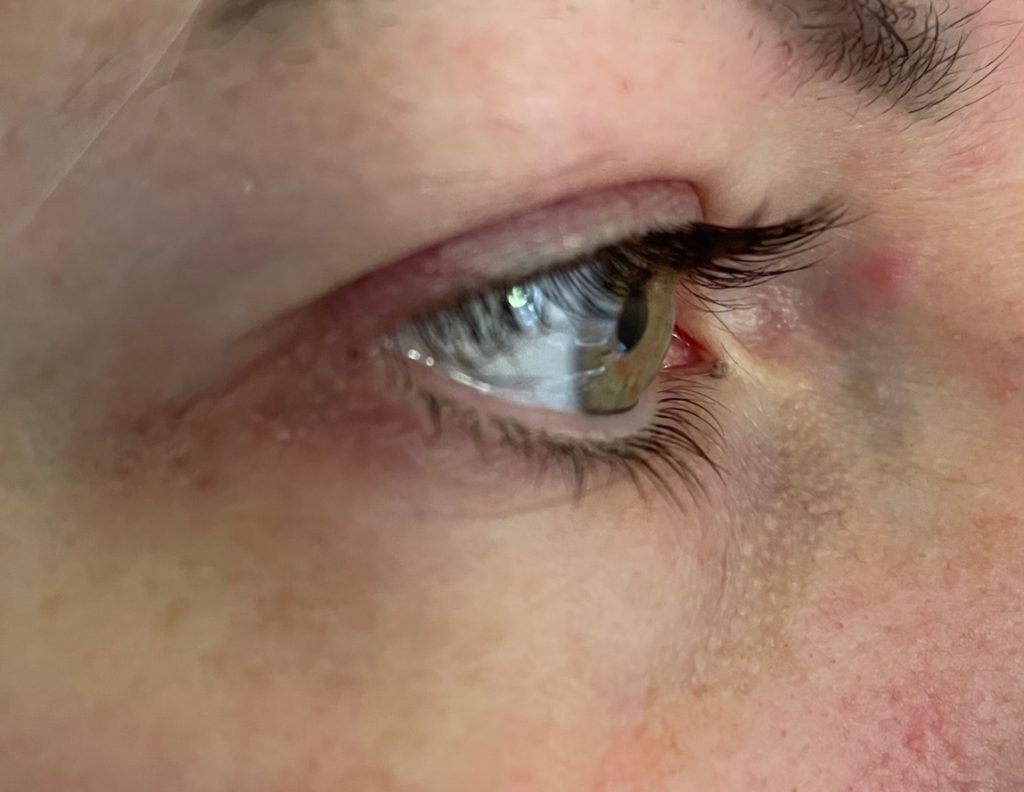 Lashcocaine Wimpernserum Rötung