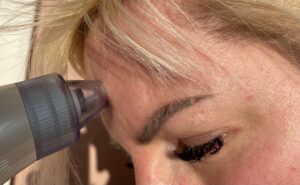 medisana PR A60 Porenreiniger im Einsatz